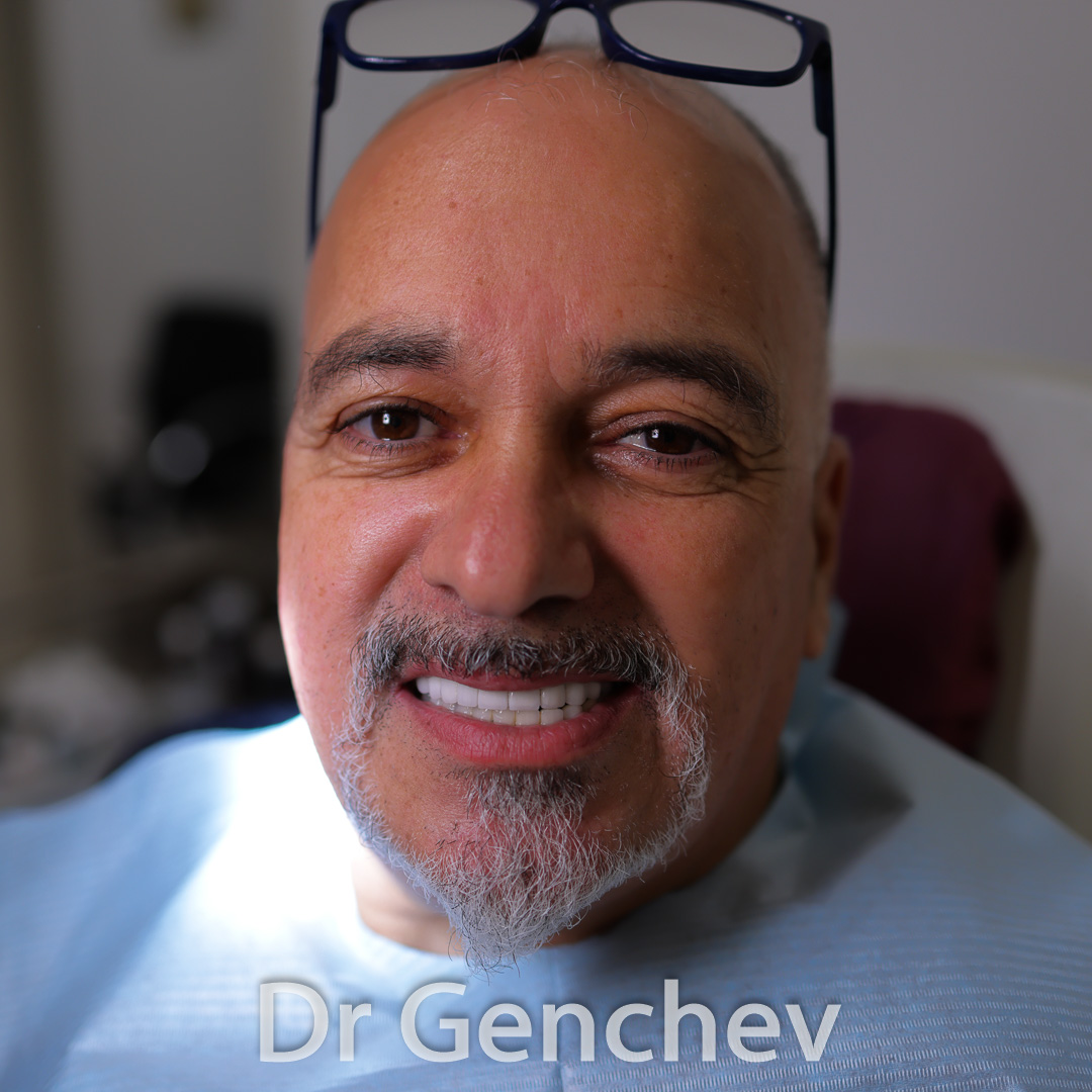 Patient of Dott Genchev after basal dental implants 