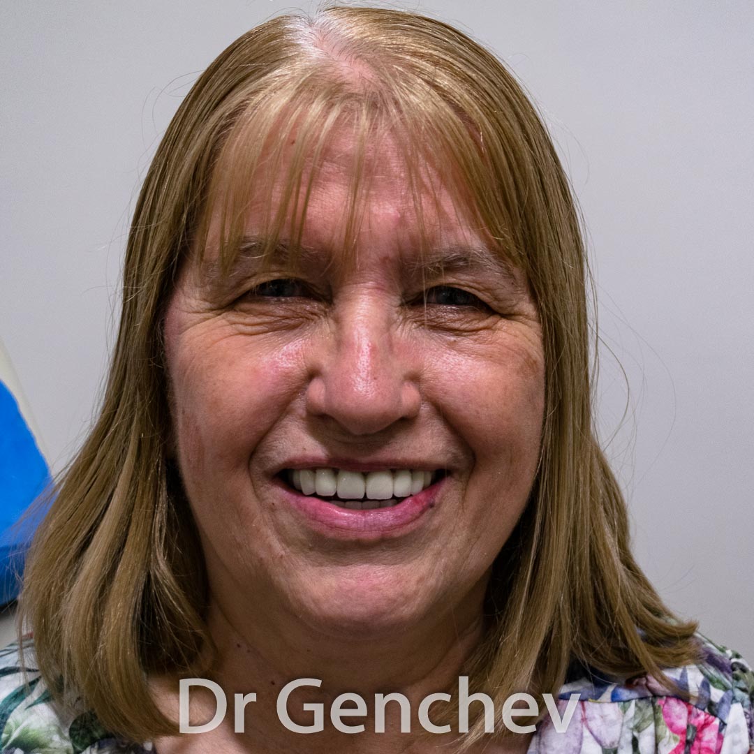 Veronique France periodontitis Dott Genchev basal implant 