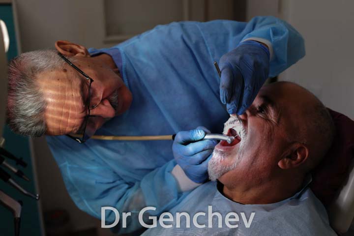 Dott Genchev fixing a basal dental implant